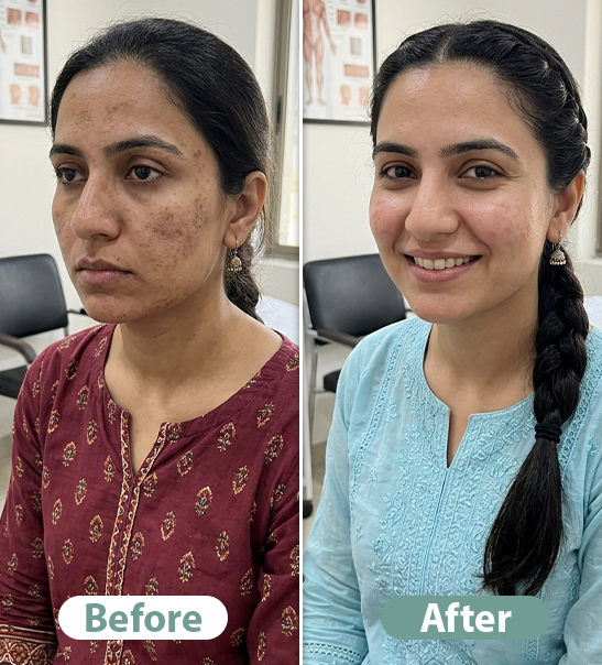 Before After Result