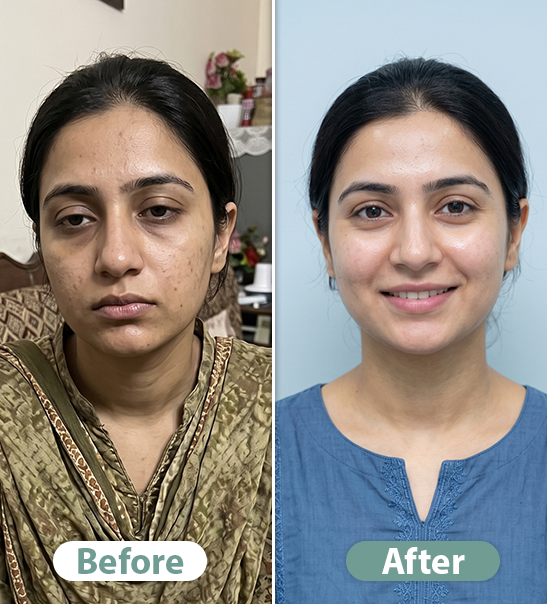 Before After Result