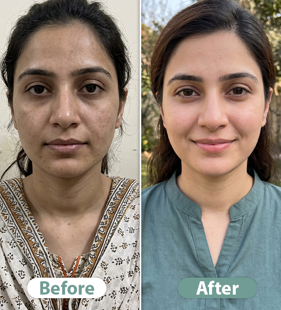 Before After Result