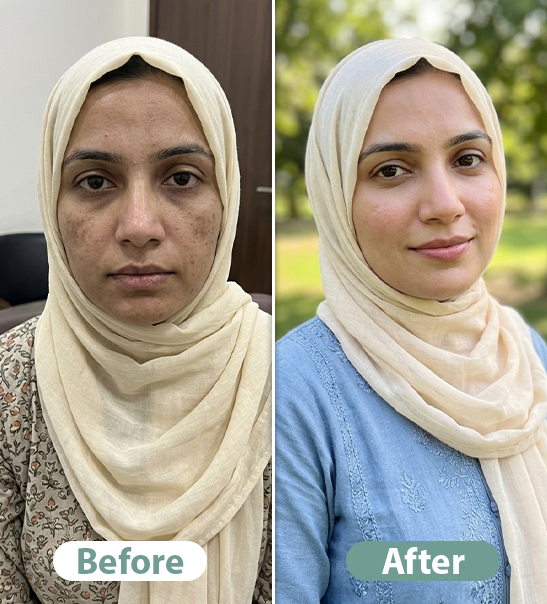 Before After Result