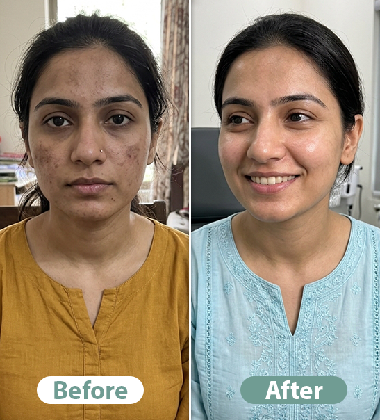 Before After Result